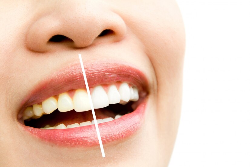 teeth whitening enamel safety teeth whitening myths and facts