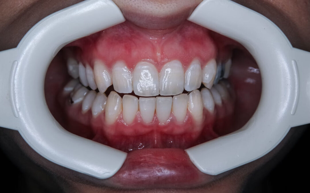 How to Maintain a Bright Smile After Teeth Whitening