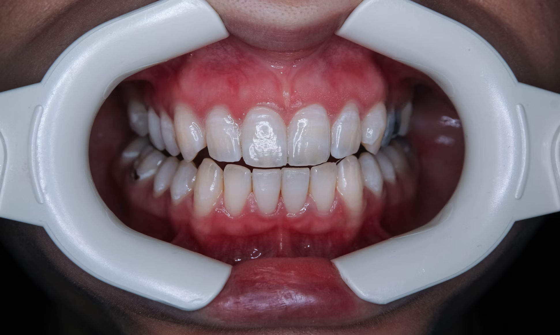 teeth whitening maintenance how to keep teeth white